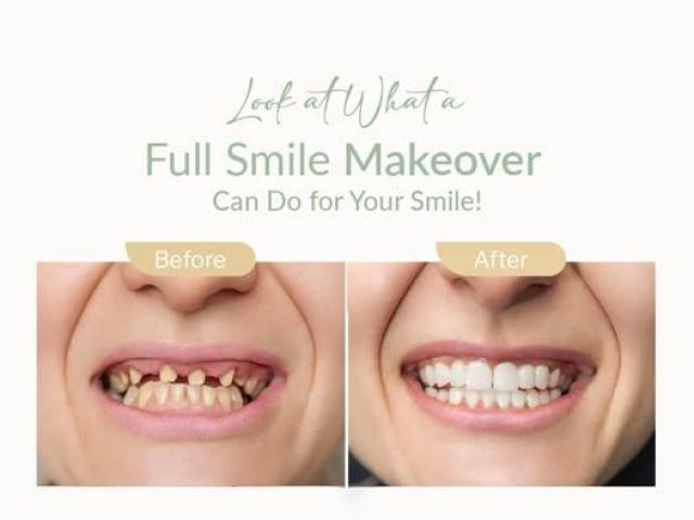 All-on-4 Implants Claremont