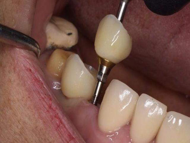 Revive your natural and flawless smiles with holistic Dental care in Tijuana
