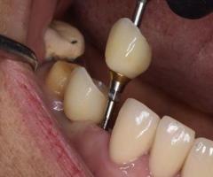 Revive your natural and flawless smiles with holistic Dental care in Tijuana