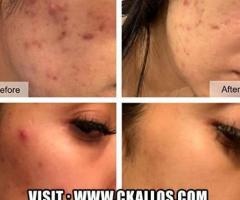 Clear Acne Fast – Proven Treatment for Pimples & Breakouts