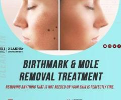 facial port wine stain Treatment in india