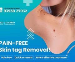 best Vitiligo Treatments in india